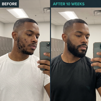 Before and after comparison of a man taking a mirror selfie, showing skin improvement over 10 weeks.